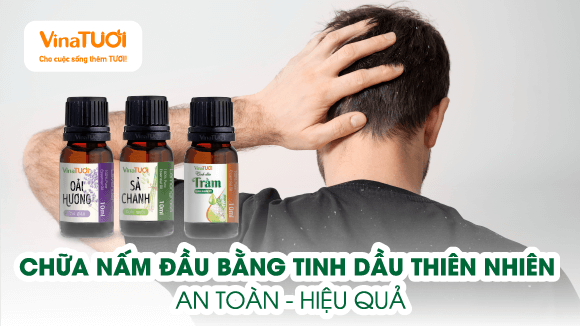 Chữa Nấm Đầu Bằng Tinh Dầu Thiên Nhiên - An Toàn Hiệu Quả