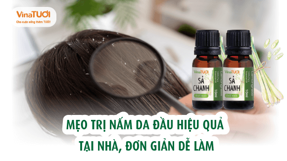 Mẹo trị nấm da đầu hiệu quả tại nhà, đơn giản dễ làm