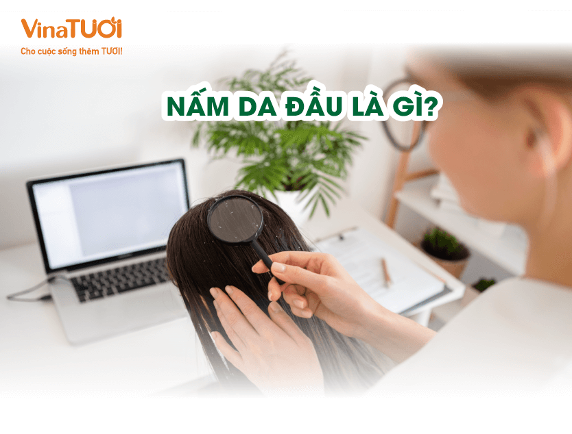 Nấm da đầu là gì?