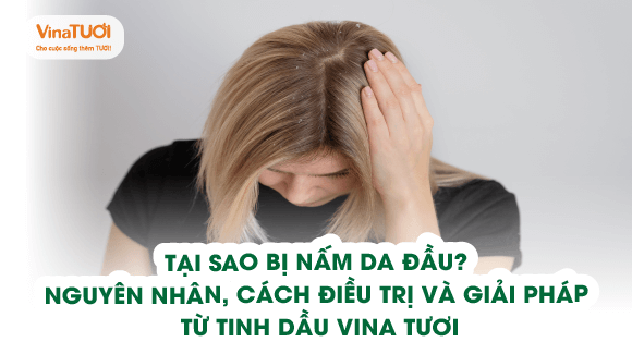 Tại sao bị nấm da đầu? Nguyên nhân, cách điều trị và giải pháp từ tinh dầu Vina Tươi